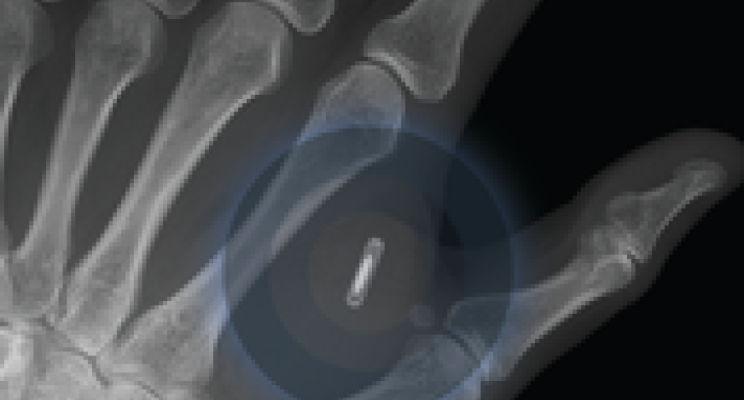 Implante de microchip para el trabajo y el ocio